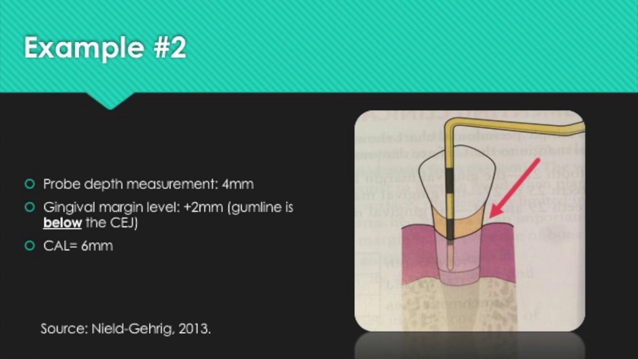 What Is Cal In Periodontal Charting