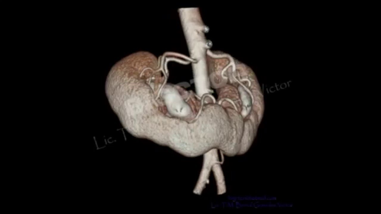 Pielolitotomia Laparoscópica en Riñón en Herradura,laparoscopic