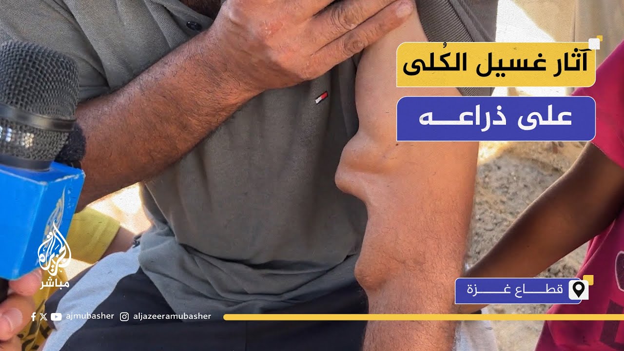 مريض كُلى بغزة: نعالج بأدوية منتهية الصلاحية إن وجدت