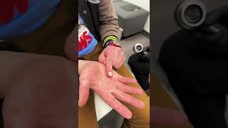 Magnet Implants in the Fingertips!