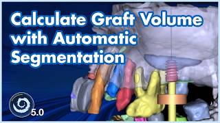 BSPV5.0 Zero Guesswork: Calculate Graft Volume with Automatic Segmentation