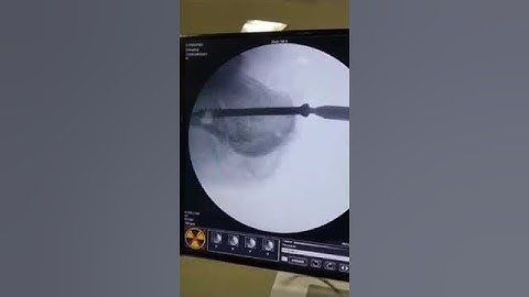 Percutaneous cannulated Screws fixation of displaced intra- articular calcaneus fractures kdmc