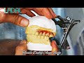 Prótesis dental semiflexible Laboratorio Dental Angie Lindo