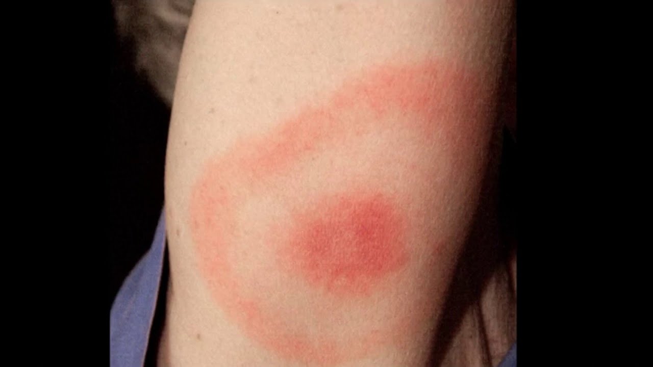 How to recognize signs of Lyme disease YouTube