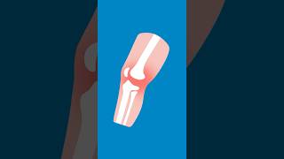 Download Lagu An HSS Orthopedic Surgeon Explains Knee Replacement | HSS MP3