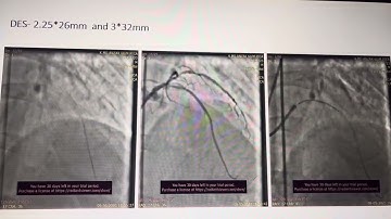 Reverse crush technique for bifurcation