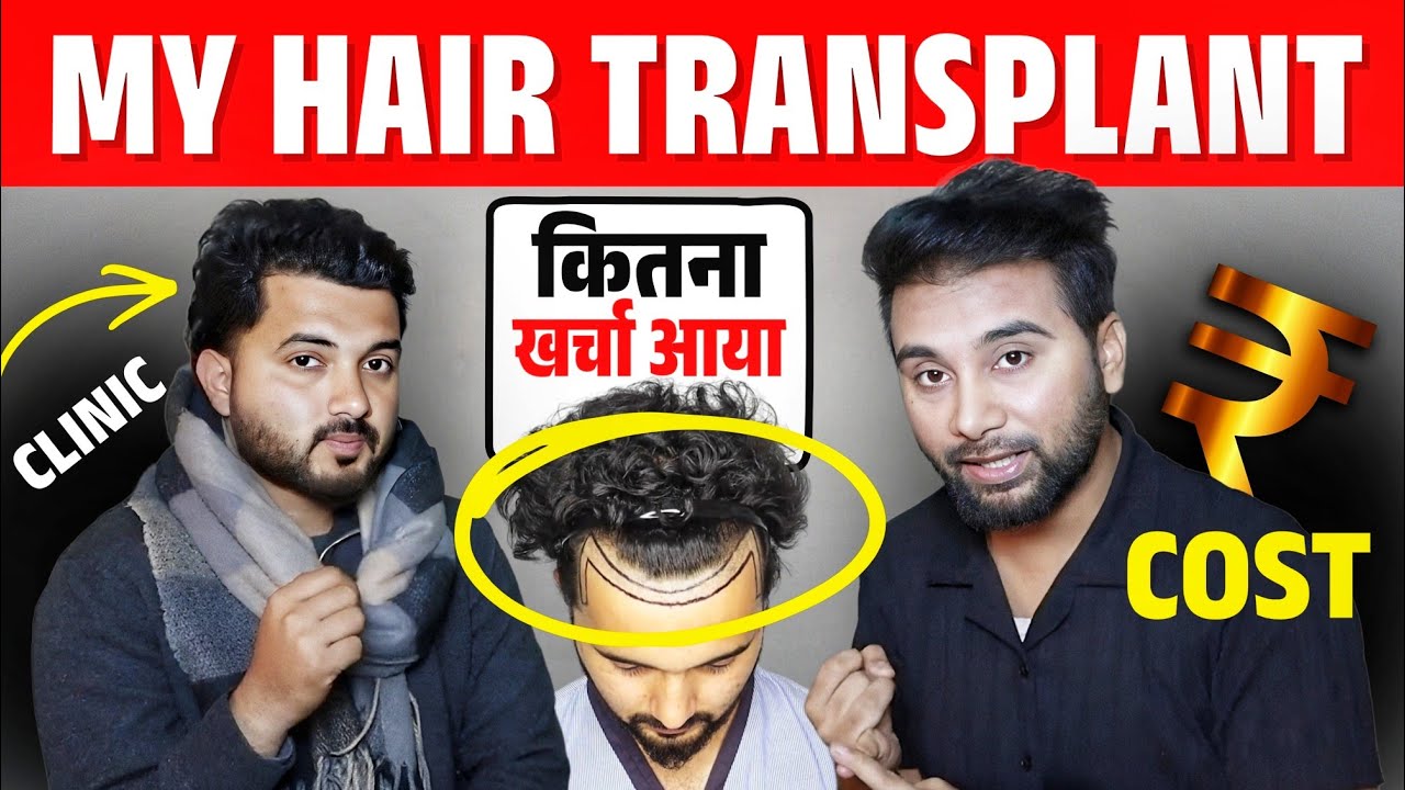 My Hair Transplant Cost, Clinic & Result 🔥🔥🔥 Day 1- 180 Hair Transplant Timelapse 