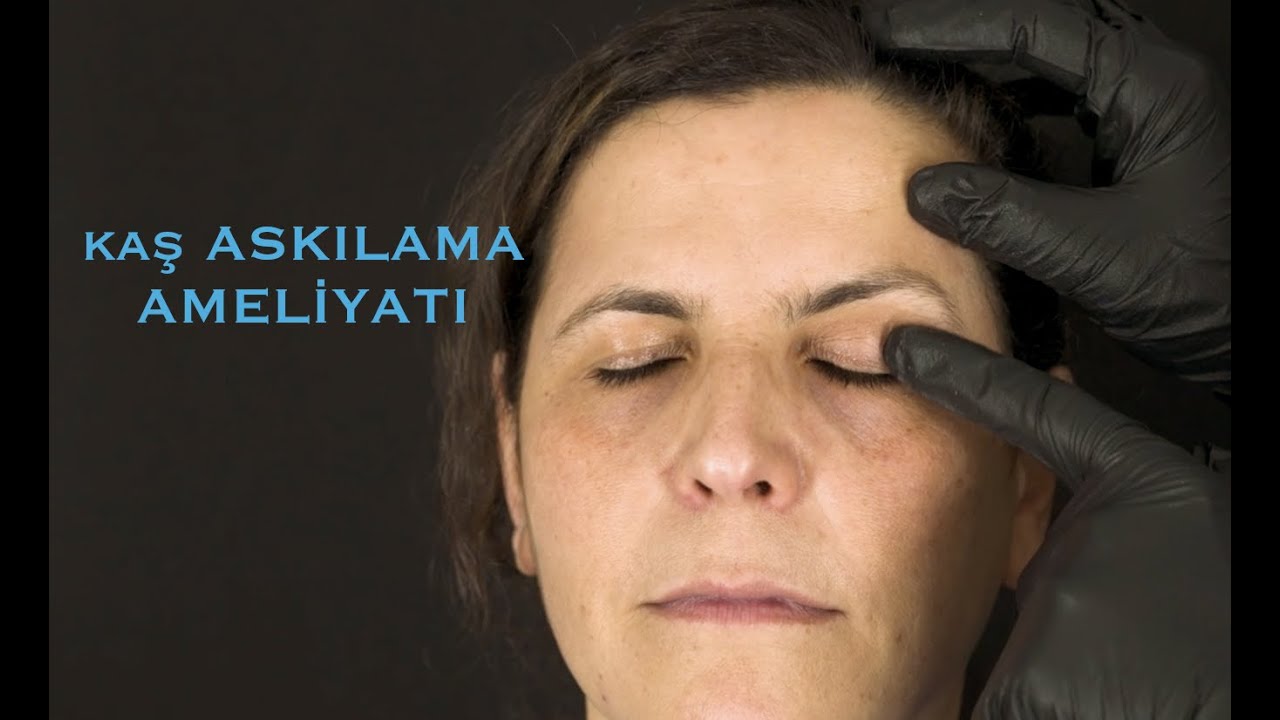Kaş askılama ameliyatı ( Endochor emilebilir implant ile )