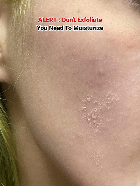 Download lagu Dry, Red & Flaky skin Needs A moisturizer #skincaretips #skincareroutine #shorts