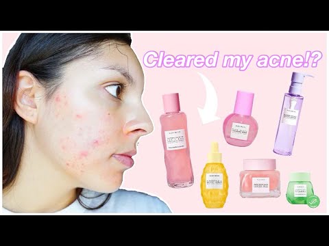 Video: Acne Masks - Reviews, Types, Recipes