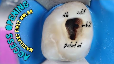 Access Opening of Maxillary First Molar | how to easily locate Mesiobuccal Canals (mb1 & mb2)