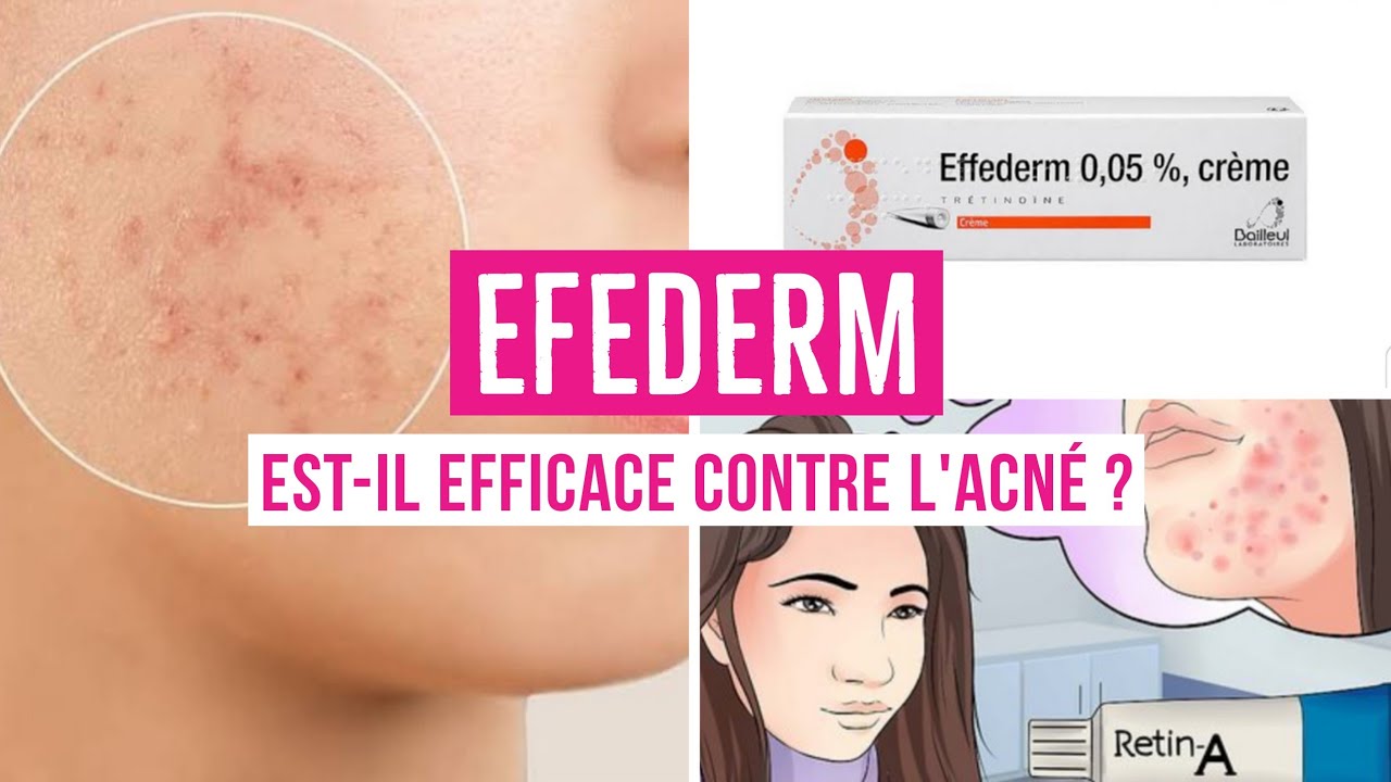 EFFEDERM 0.05 CRÈME - TOUT CE QUE VOUS DEVEZ SAVOIRSUR CE MÉDICAMENT