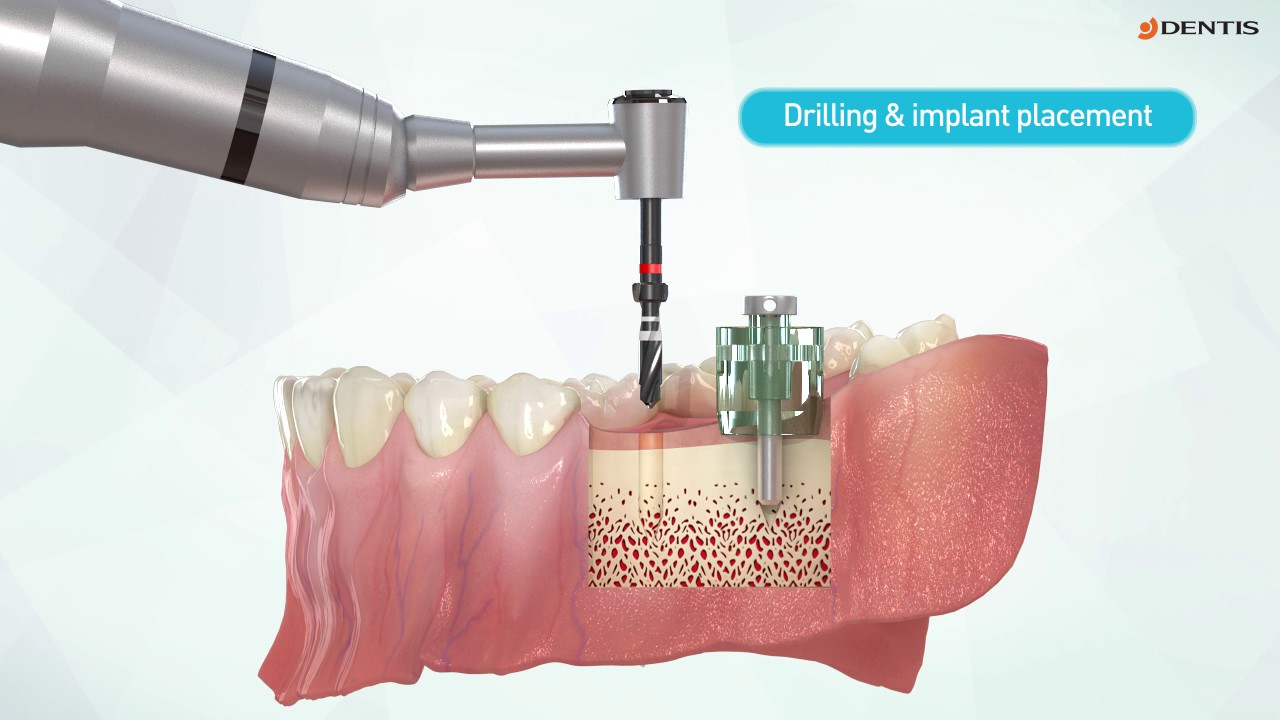 DENTIS Surgical Guide Tool Guide Wheel YouTube