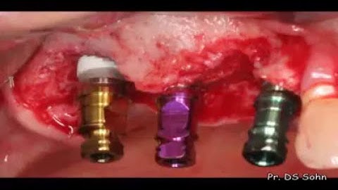 Sinus augmentation using HPISE and Ridge Augmentation