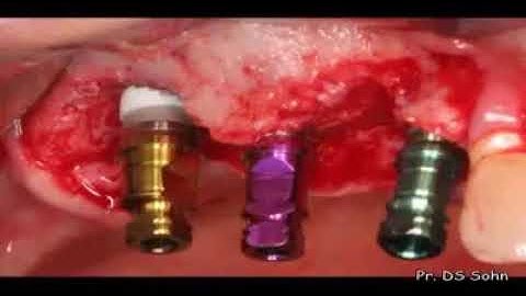 Sinus augmentation using HPISE and Ridge Augmentation