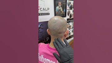 Xăm tóc hói sau hơn 6 năm #vnscalp #xamchantoc