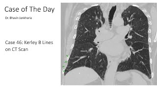 Case of the Day - 046 - 2025 06 04 - Kerley B Lines on CT Scan
