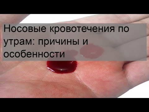 Носовые кровотечения по утрам: причины и особенности