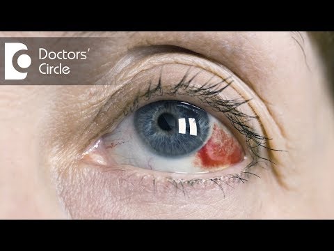 Video: If The Eye Turns Red - What To Do? The Child's Eye Turned Red