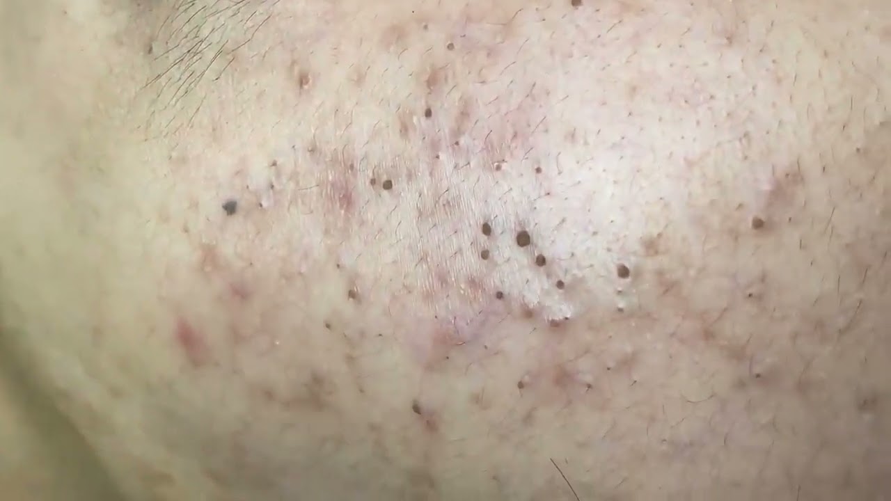 blackhead removel..releks and enjoy