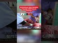 Anonymous Hero Donates Hospital 200 Human Kidneys