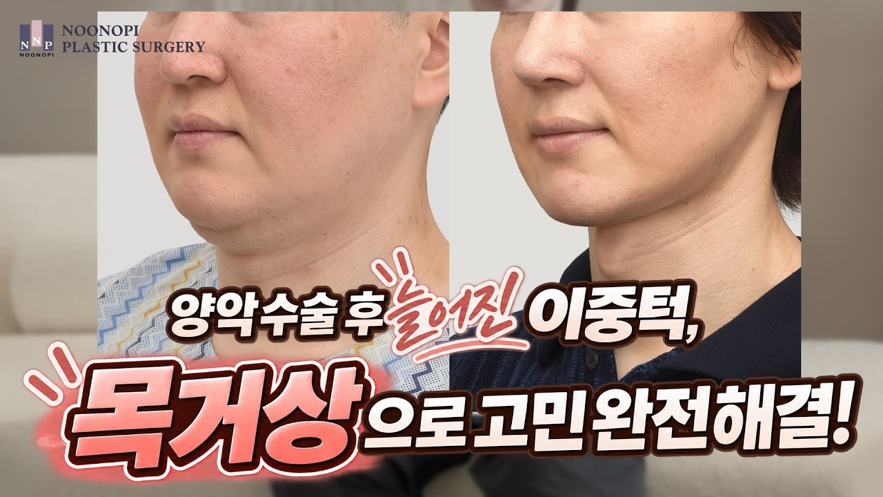 양악수술 10년 후 생긴 이중턱, 지방흡입 대신 목거상을 선택한 이유 | 실제 환자 인터뷰