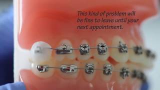 Braces Emergencies! - Fixes! How To Fix Broken Braces at Home if Orthodontist is Closed