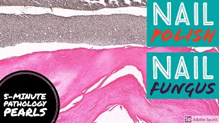 Nail Fungus (Onychomycosis) & Nail Polish: 5-Minute Pathology Pearls