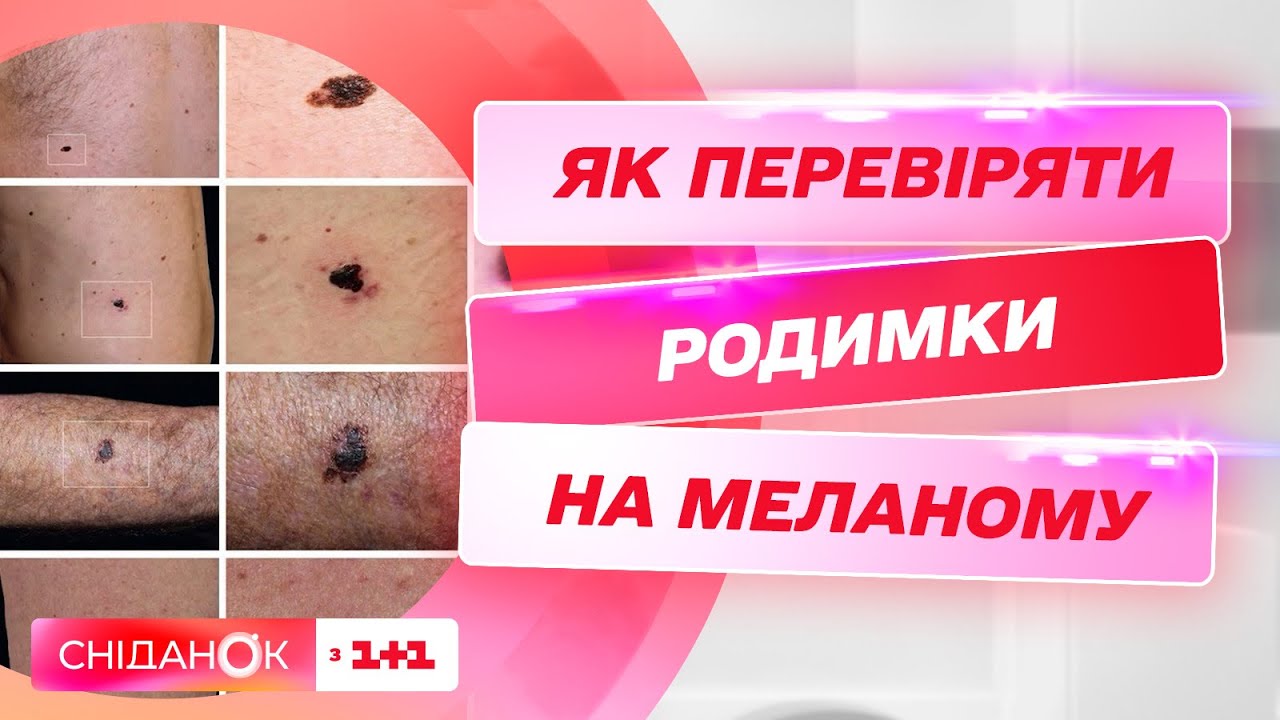 Як самостійно перевіряти родимки? Пояснює лікар-онколог Микола ...