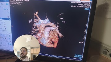CT pulmonary Angiography Procedure. Detailed Explanation part-2 @avnishradiology