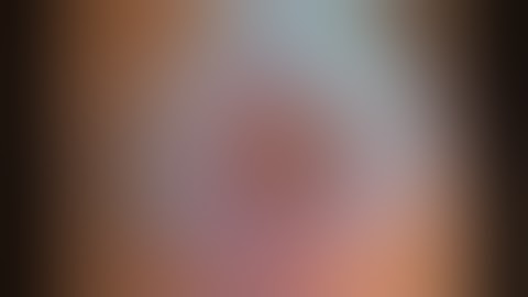 Dislocated IOL: Scleral Fixation Sutures with Hoffman pockets - Dr Simon Chen