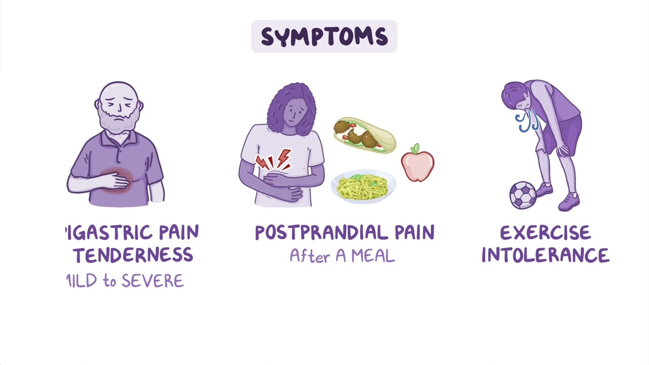 Median Arcuate Ligament Syndrome (MALS) Los Angeles, CA | Dr. Danny Shouhed