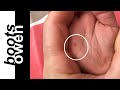 Quick and easy way to remove a stubborn thorn or splinter in an infant or baby&#39;s hand
