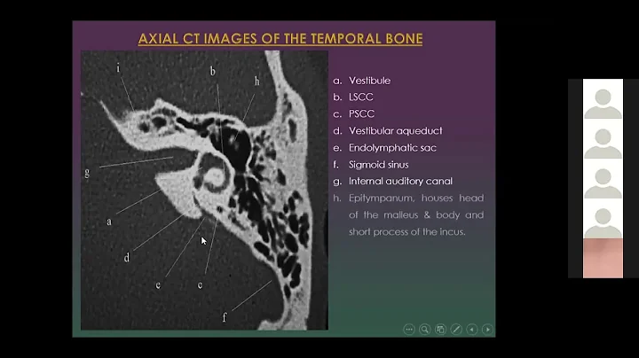 Enlarged Vestibular Aqueduct with Dr. Ghada Wageih (part 2 of 2)