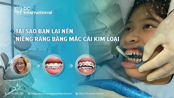 Tại Sao Bạn Nên Niềng Răng Bằng Mắc Cài Kim Loại! Dr Cường