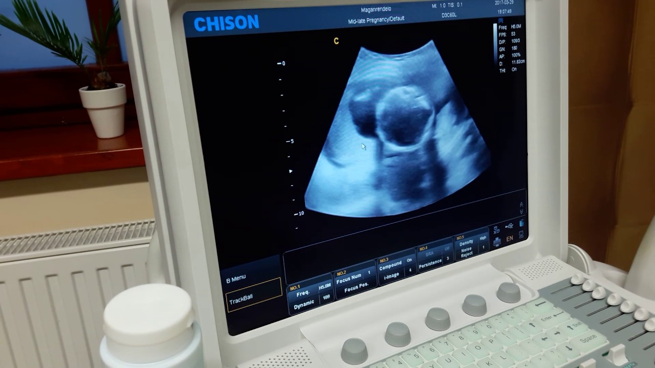 Pataki Lilla 17. heti ultrahang