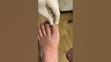 Look how easy this toenail comes off! 😳🤯 #shorts #nails