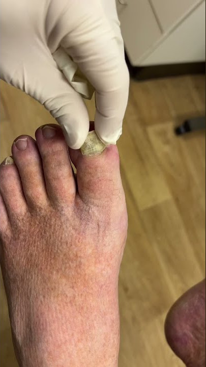 Look how easy this toenail comes off! 😳🤯 #shorts #nails