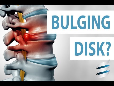 How to prevent a bulging disc - Simple exercises