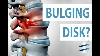 How to prevent a bulging disc - Simple exercises
