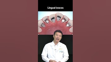 Niềng Răng Mặt Lưỡi?