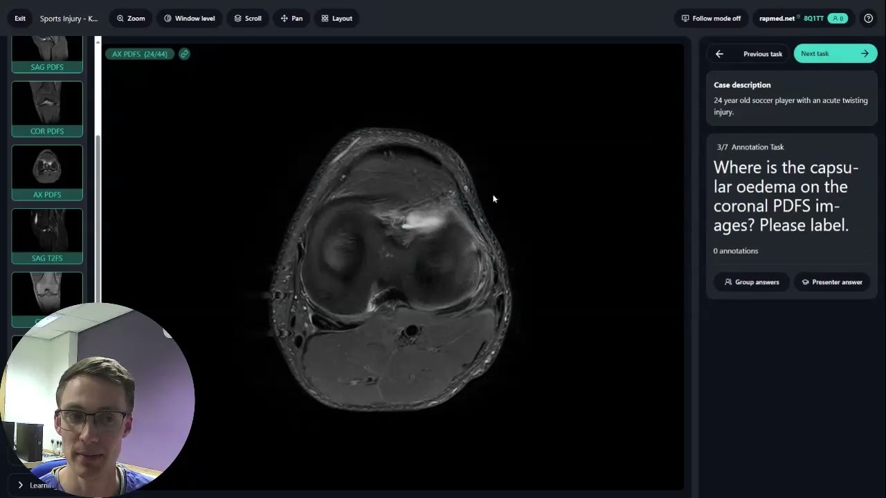 Watch RADGames ESSR Case 4 - Lateral Meniscus Tear by Henry de Boer on YouTube Watch RADGames ESSR Case 4 - Lateral Meniscus Tear by Henry de Boer on YouTube