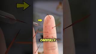Celebrity Got Cactus Spines in Your Skin? Try This Simple Trick  #viral Profile