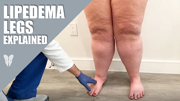 Lipedema Legs Explained | Dr. Jaime Schwartz | Tot...