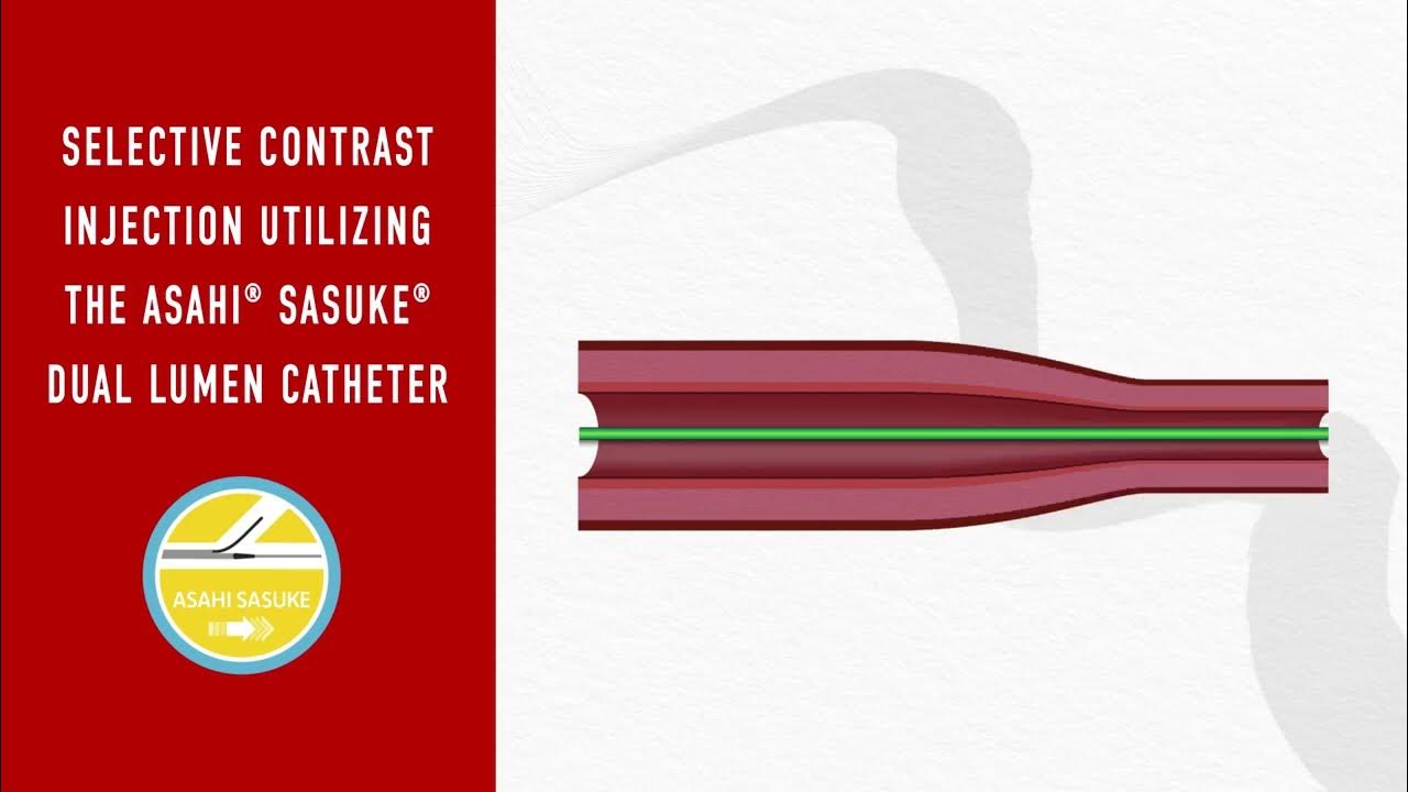 Selective Contrast Injection DualLumen Catheter Tutorial YouTube