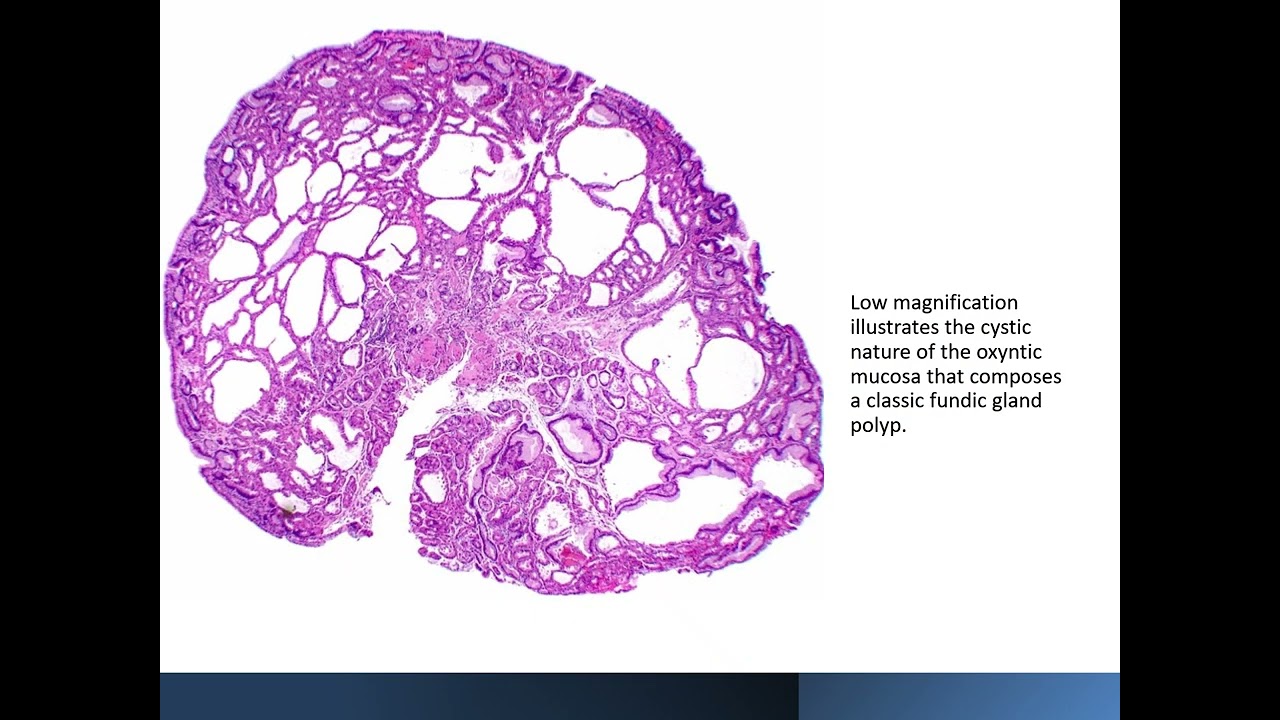 Fundic Gland Polyp