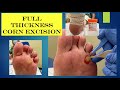 video - full thickness corn excision