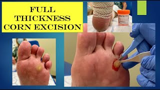 video - full thickness corn excision