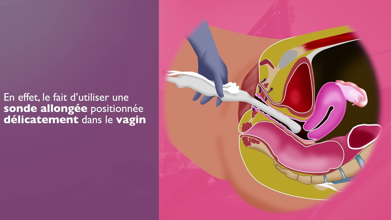 l'échographie endovaginale