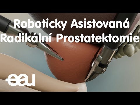 Video: Kdy provést transuretrální prostatektomii?